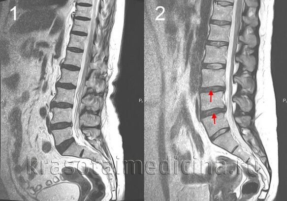 Osteochondroza páteře