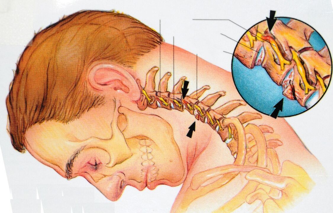 Osteochondroza v oblasti děložního čípku